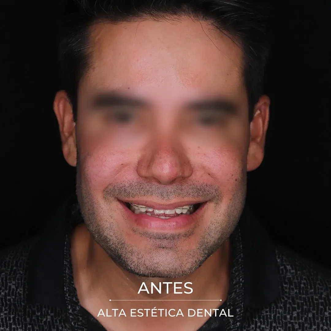 Fotografía clínica antes de un caso realizado en Alta Estética Dental.