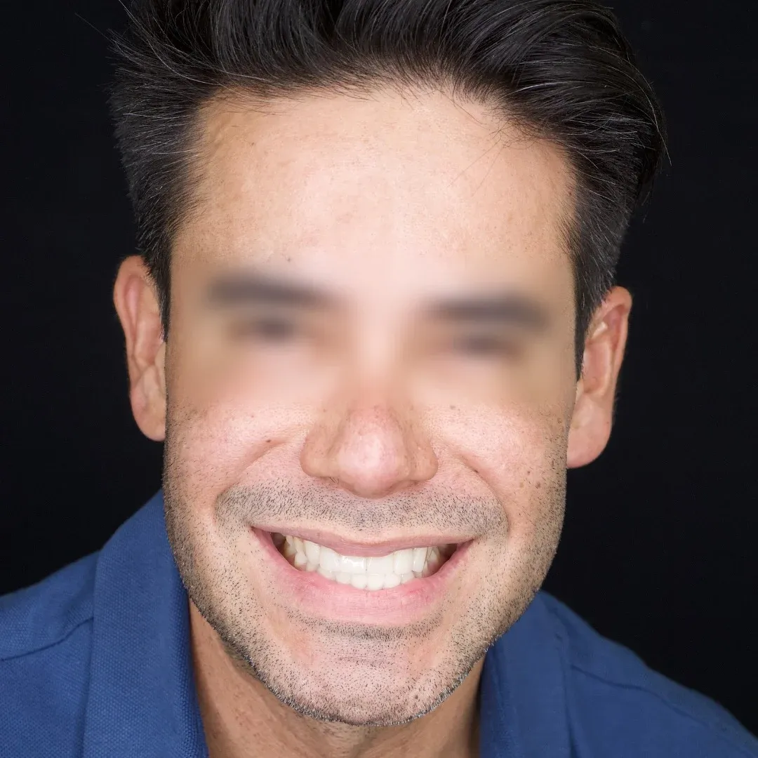 Fotografía clínica después de un caso realizado en Alta Estética Dental.