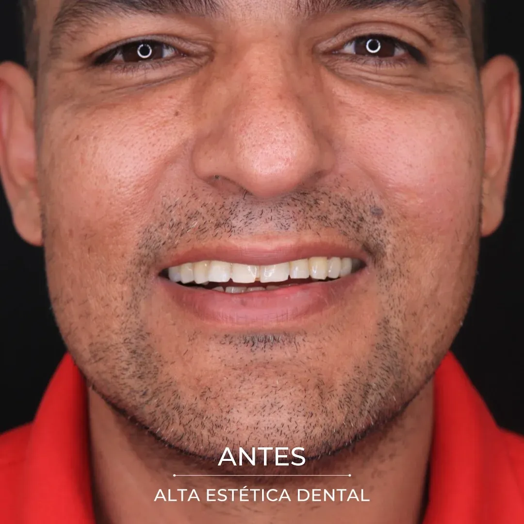 Fotografía clínica antes de un caso realizado en Alta Estética Dental.