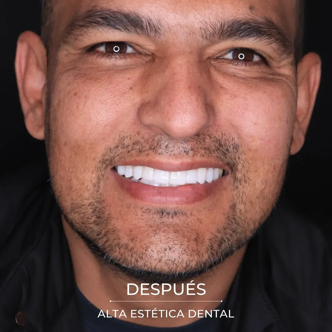 Fotografía clínica después de un caso realizado en Alta Estética Dental.