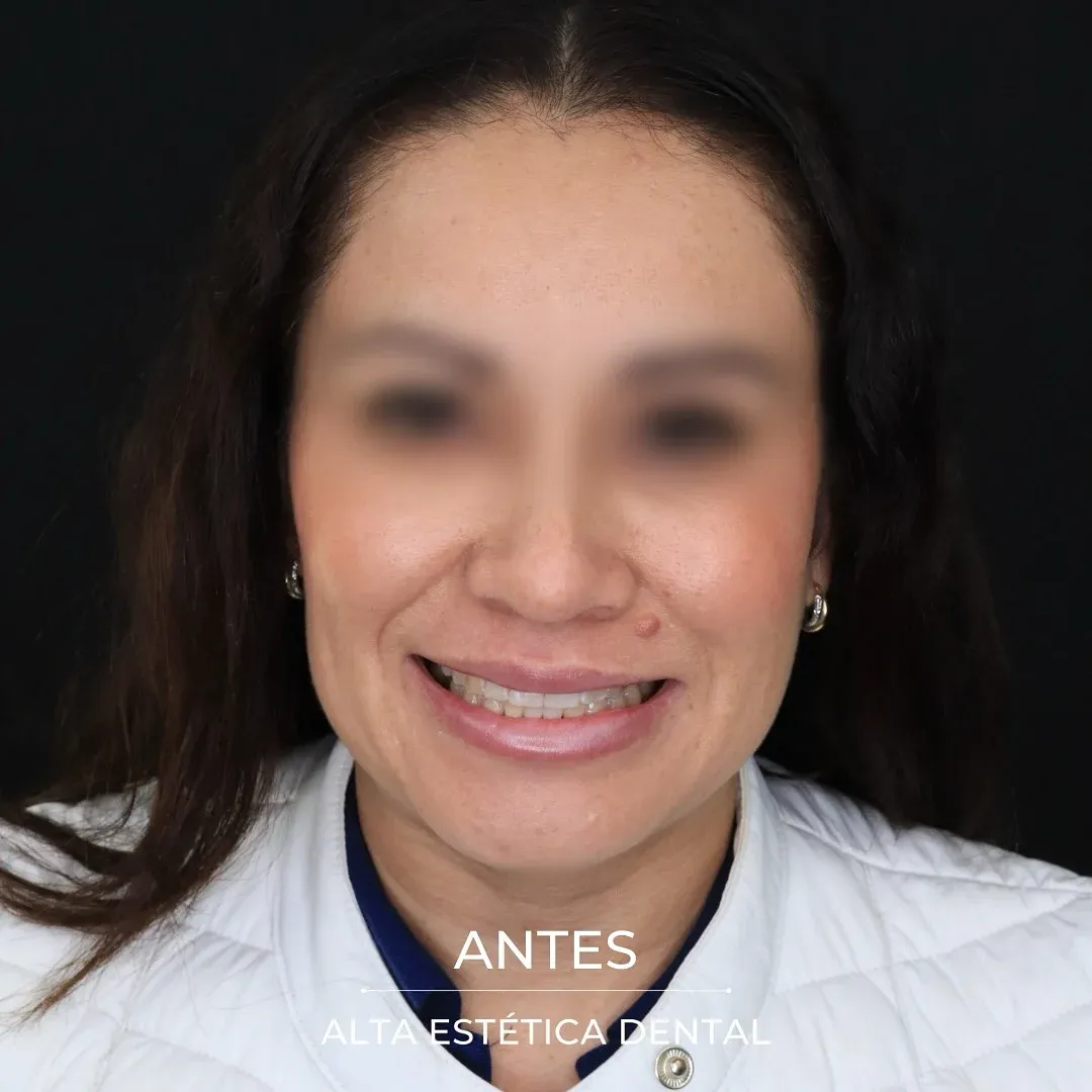Fotografía clínica antes de un caso realizado en Alta Estética Dental.