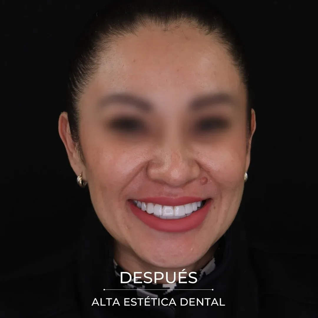 Fotografía clínica después de un caso realizado en Alta Estética Dental.