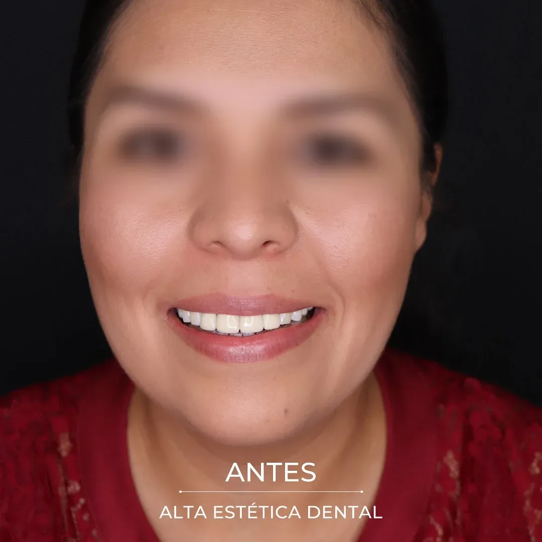 Fotografía clínica antes de un caso realizado en Alta Estética Dental.