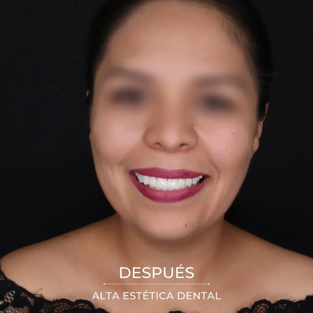 Fotografía clínica después de un caso realizado en Alta Estética Dental.