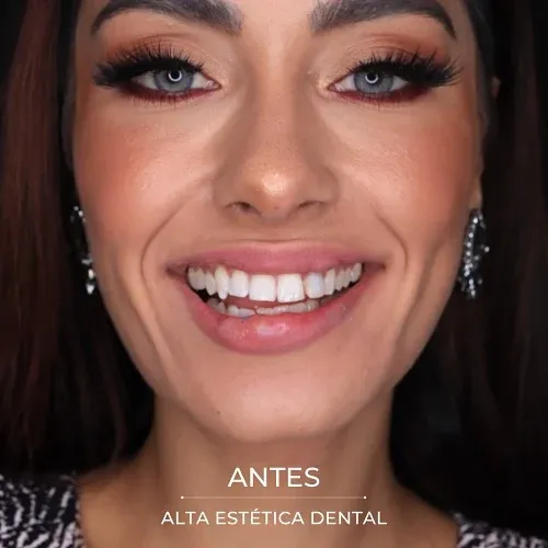 Fotografía clínica antes de un caso realizado en Alta Estética Dental.