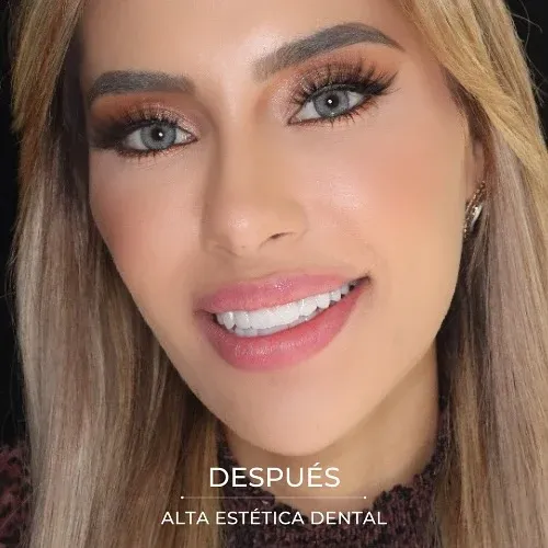 Fotografía clínica después de un caso realizado en Alta Estética Dental.