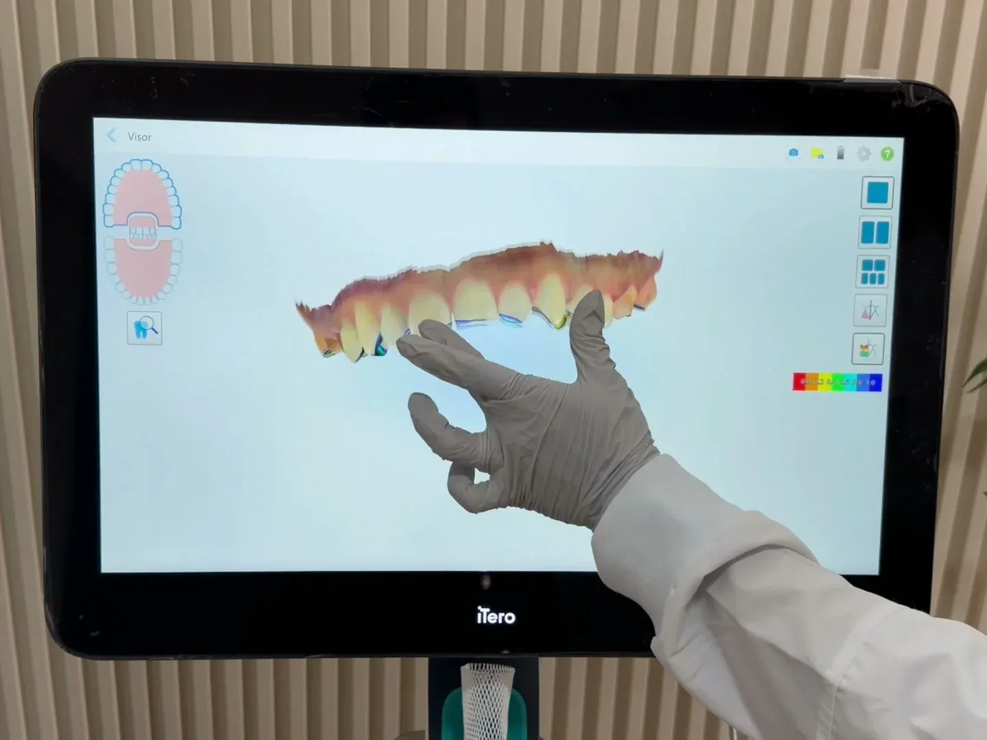 Pantalla del escáner intraoral con el registro 3D a color de una arcada y una mano con guante que lo gira.