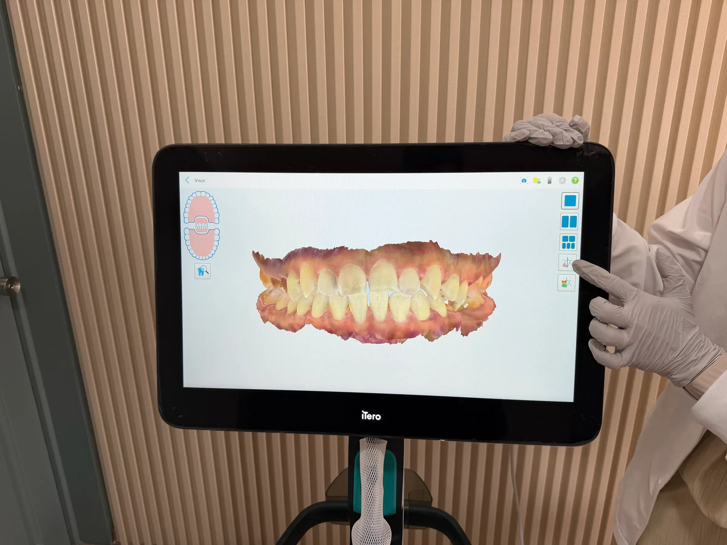 Pantalla del escáner intraoral con el modelo 3D de una sonrisa y una mano con guante que señala la mordida.